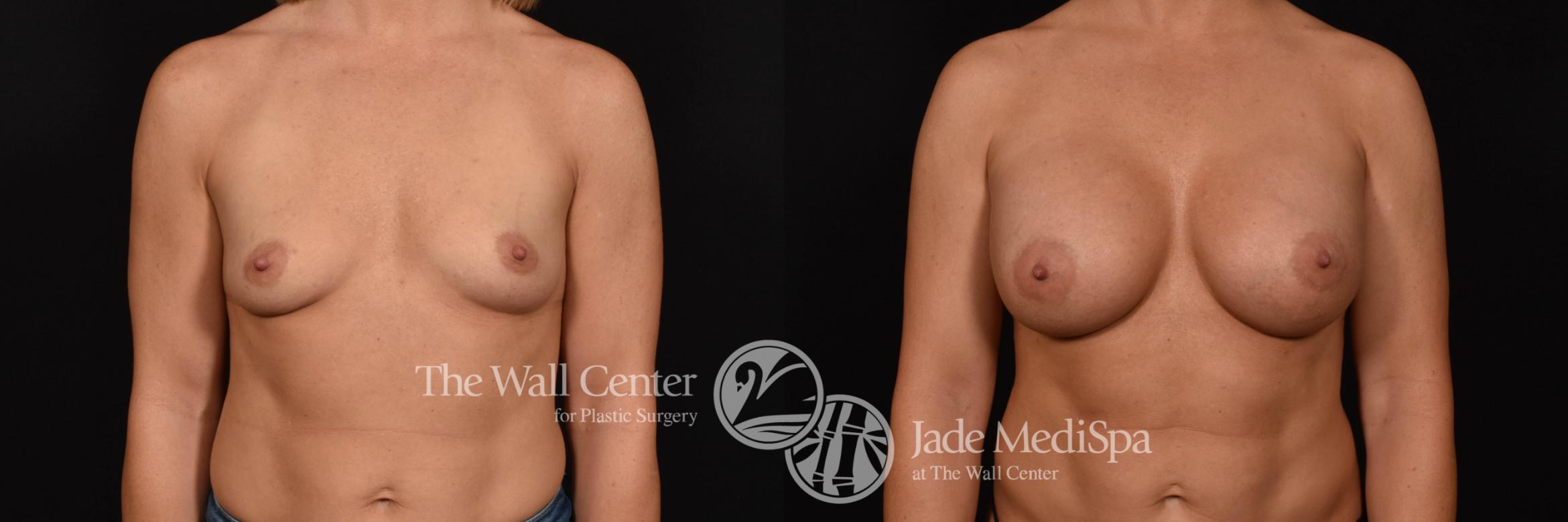 Breast Augmentation Front Photo, Shreveport, Louisiana, The Wall Center for Plastic Surgery, Case 942
