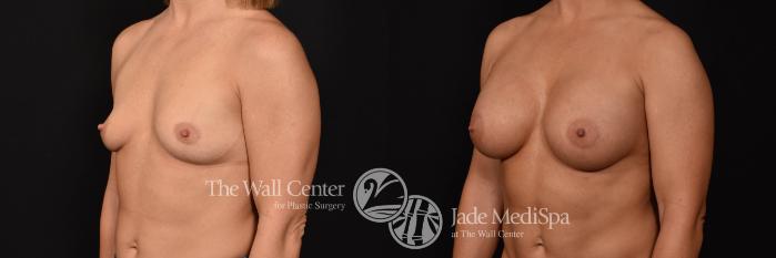 Breast Augmentation Left Oblique Photo, Shreveport, Louisiana, The Wall Center for Plastic Surgery, Case 942