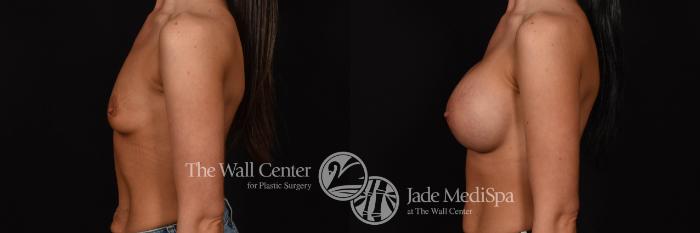 Breast Augmentation Left Side Photo, Shreveport, Louisiana, The Wall Center for Plastic Surgery, Case 953