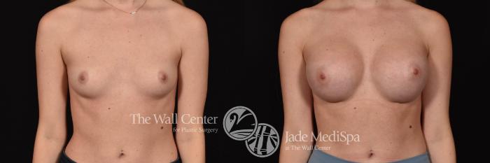 Breast Augmentation Front Photo, Shreveport, Louisiana, The Wall Center for Plastic Surgery, Case 958