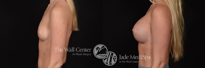 Breast Augmentation Left Side Photo, Shreveport, Louisiana, The Wall Center for Plastic Surgery, Case 958