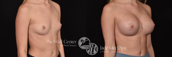 Breast Augmentation Right Oblique Photo, Shreveport, Louisiana, The Wall Center for Plastic Surgery, Case 958