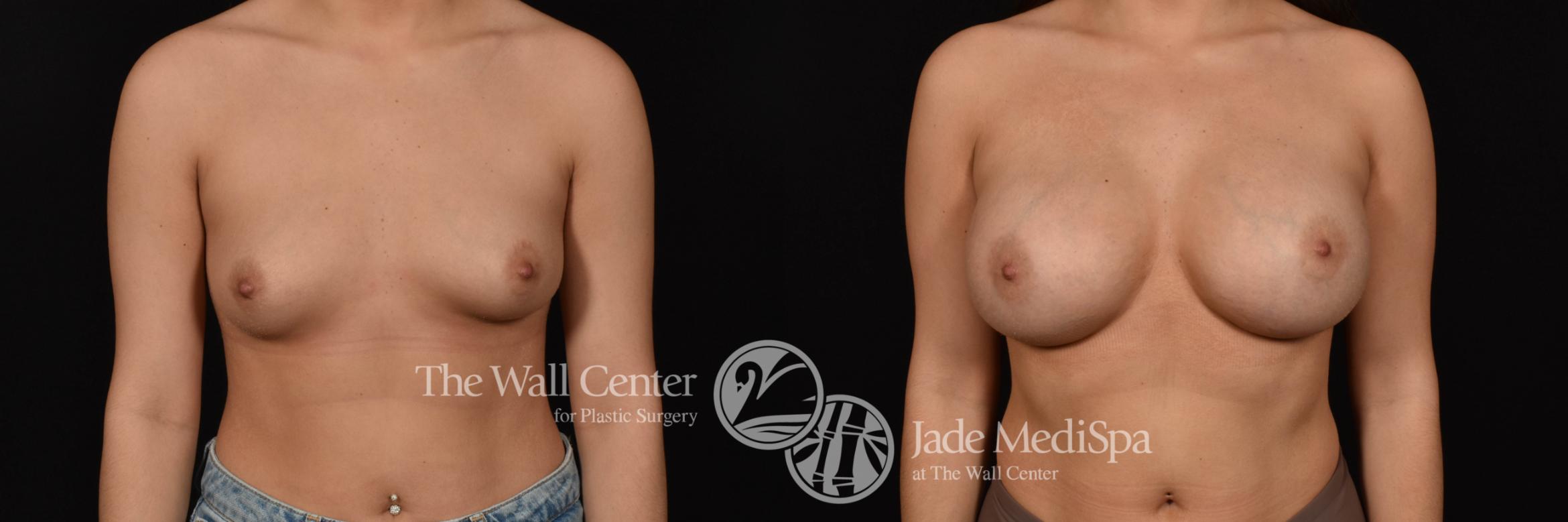 Breast Augmentation Front Photo, Shreveport, Louisiana, The Wall Center for Plastic Surgery, Case 961
