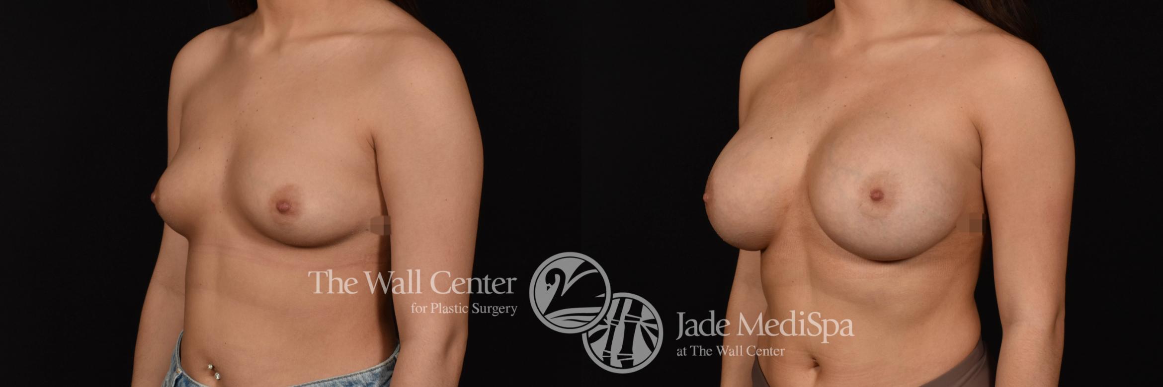 Breast Augmentation Left Oblique Photo, Shreveport, Louisiana, The Wall Center for Plastic Surgery, Case 961