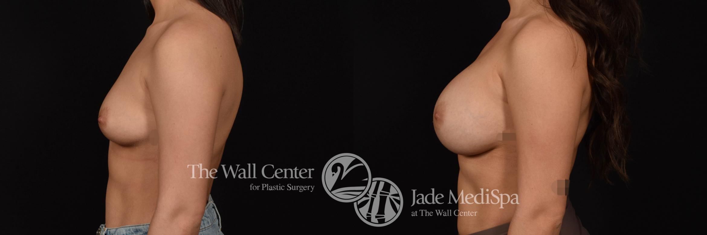 Breast Augmentation Left Side Photo, Shreveport, Louisiana, The Wall Center for Plastic Surgery, Case 961