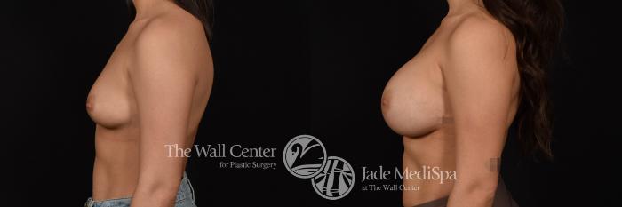 Breast Augmentation Left Side Photo, Shreveport, Louisiana, The Wall Center for Plastic Surgery, Case 961