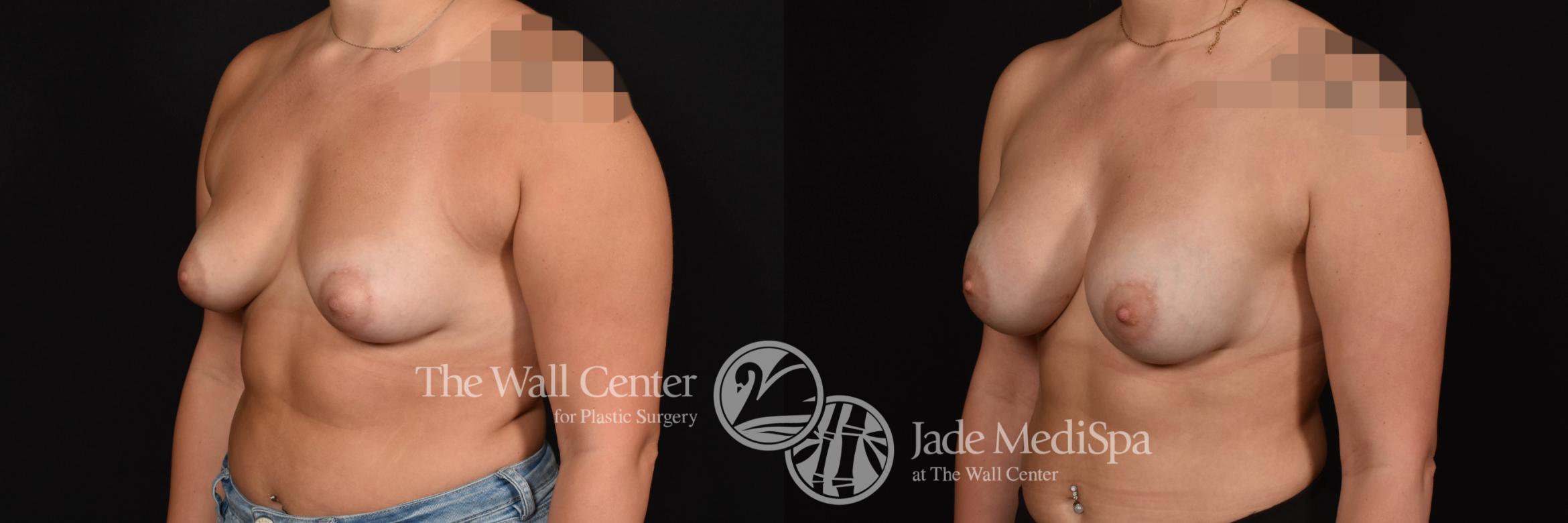 Breast Augmentation Left Oblique Photo, Shreveport, Louisiana, The Wall Center for Plastic Surgery, Case 965