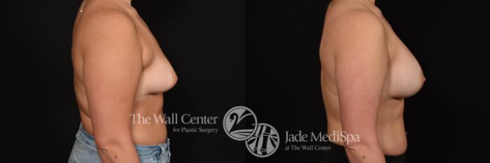 Breast Augmentation Right Side Photo, Shreveport, Louisiana, The Wall Center for Plastic Surgery, Case 965