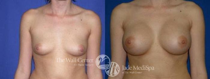 Before & After Breast Augmentation Case 99 View #1 View in Shreveport, LA