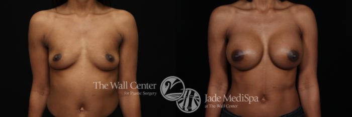 Before & After Breast Augmentation Case 993 Front View in Shreveport, LA