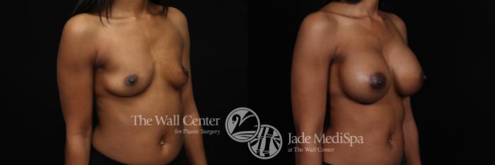 Before & After Breast Augmentation Case 993 Right Oblique View in Shreveport, LA