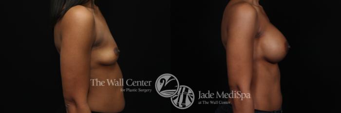 Before & After Breast Augmentation Case 993 Right Side View in Shreveport, LA