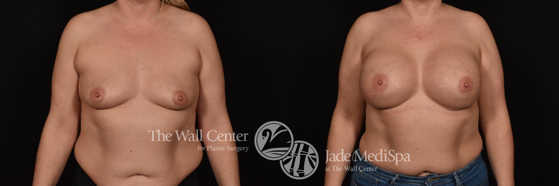Before & After Breast Augmentation Case 997 Front View in Shreveport, LA
