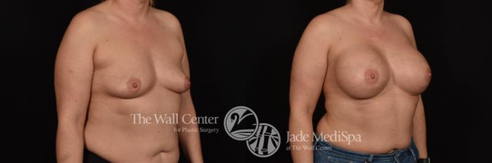 Before & After Breast Augmentation Case 997 Right Oblique View in Shreveport, LA