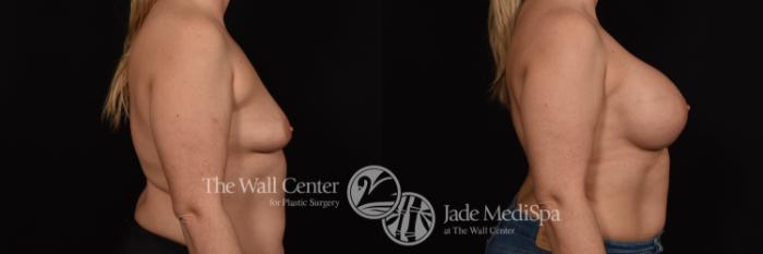 Before & After Breast Augmentation Case 997 Right Side View in Shreveport, LA