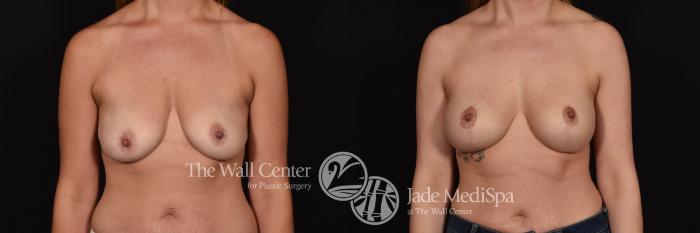 Before & After Breast Augmentation with Lift Case 1002 Front View in Shreveport, LA