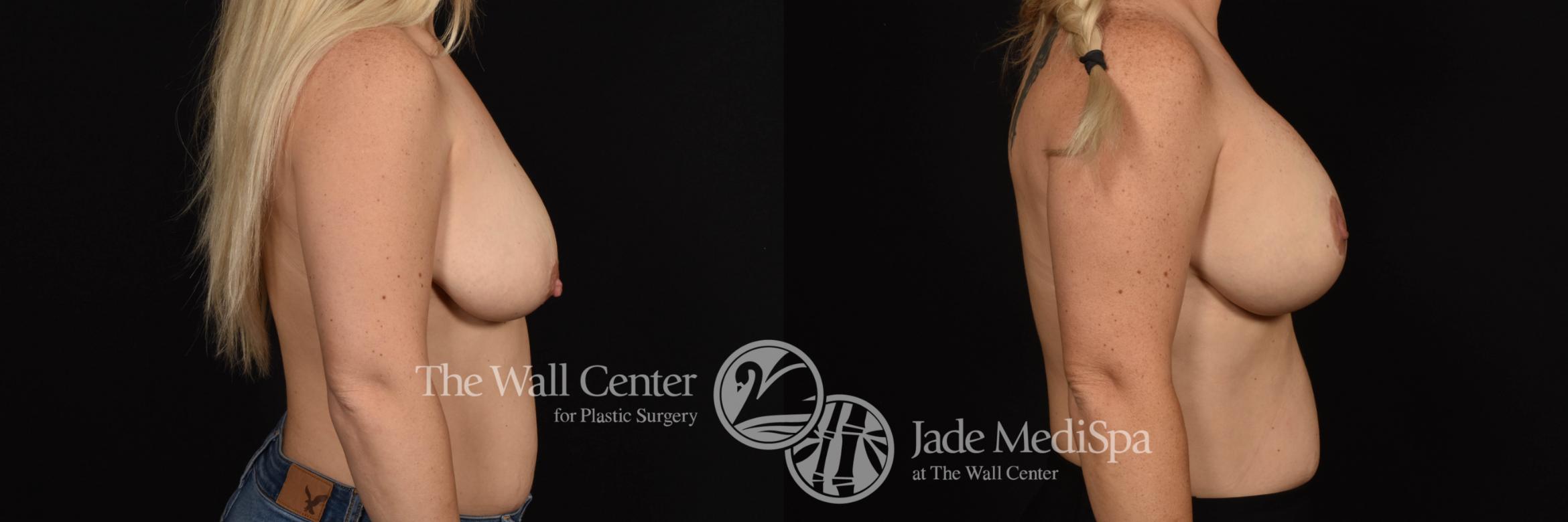 Before & After Breast Augmentation with Lift Case 1003 Right Side View in Shreveport, LA