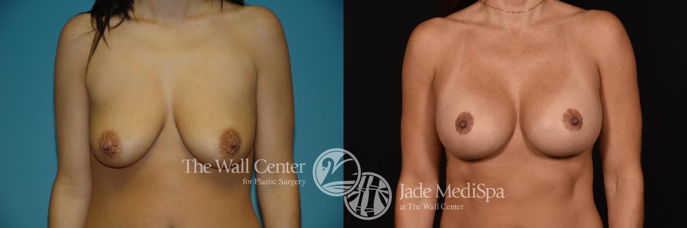 Before & After Breast Augmentation with Lift Case 1010 Front View in Shreveport, LA