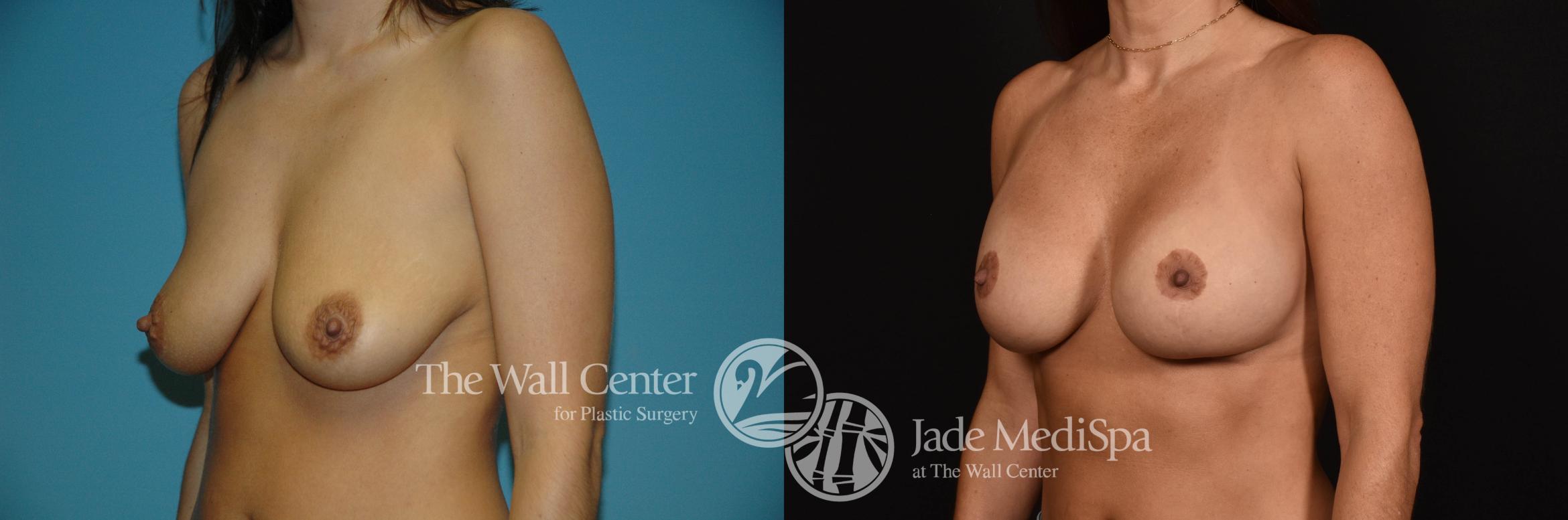 Before & After Breast Augmentation with Lift Case 1010 Left Oblique View in Shreveport, LA