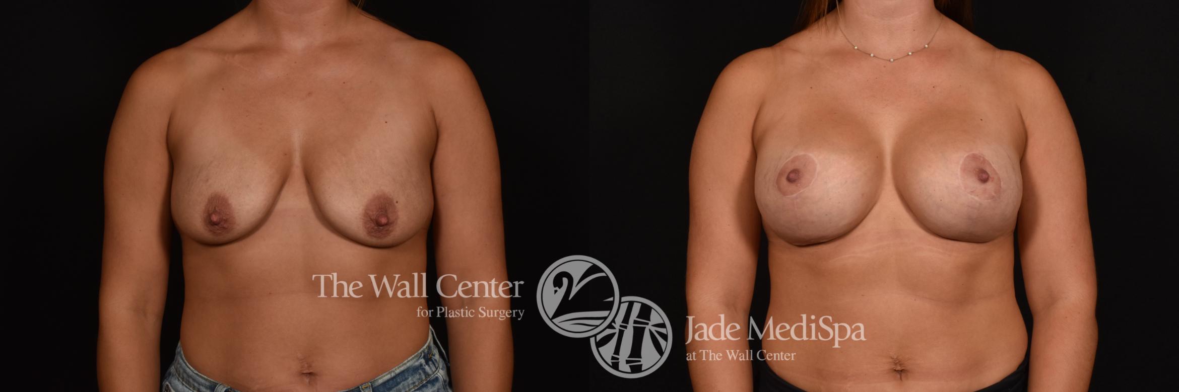 Before & After Breast Augmentation with Lift Case 1012 Front View in Shreveport, LA