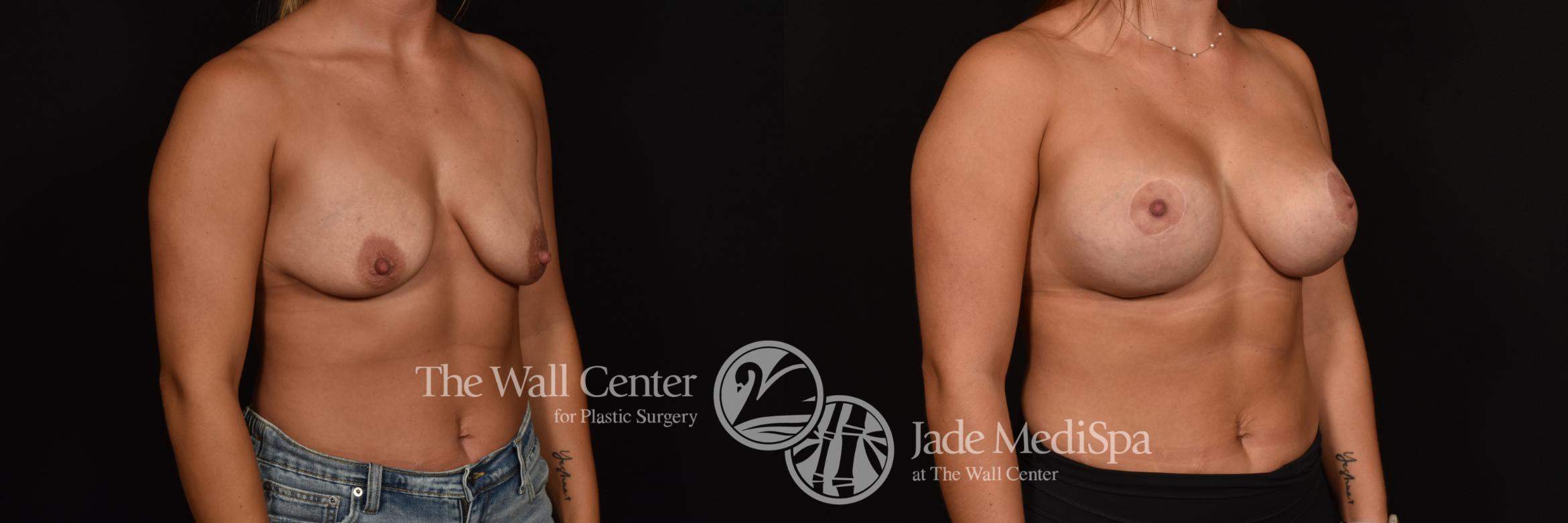 Before & After Breast Augmentation with Lift Case 1012 Right Oblique View in Shreveport, LA