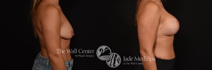Before & After Breast Augmentation with Lift Case 1012 Right Side View in Shreveport, LA