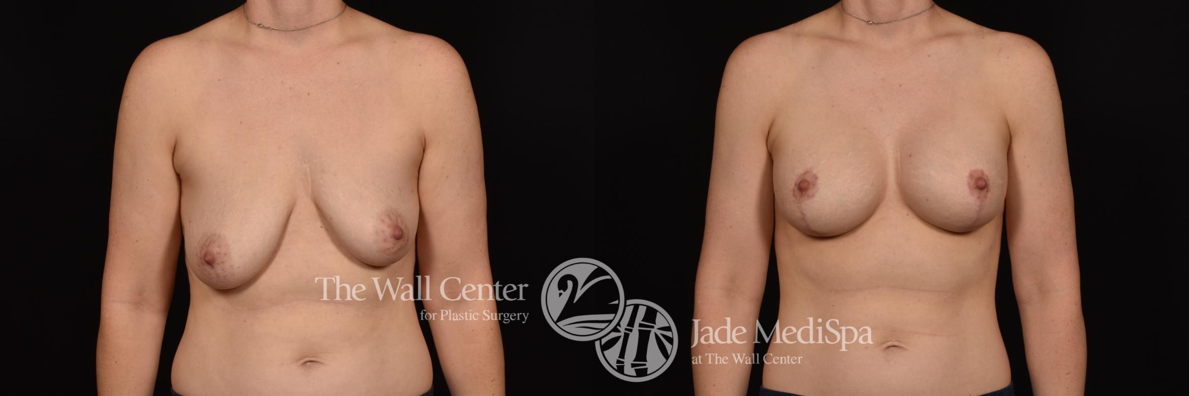 Before & After Breast Augmentation with Lift Case 1016 Front View in Shreveport, LA