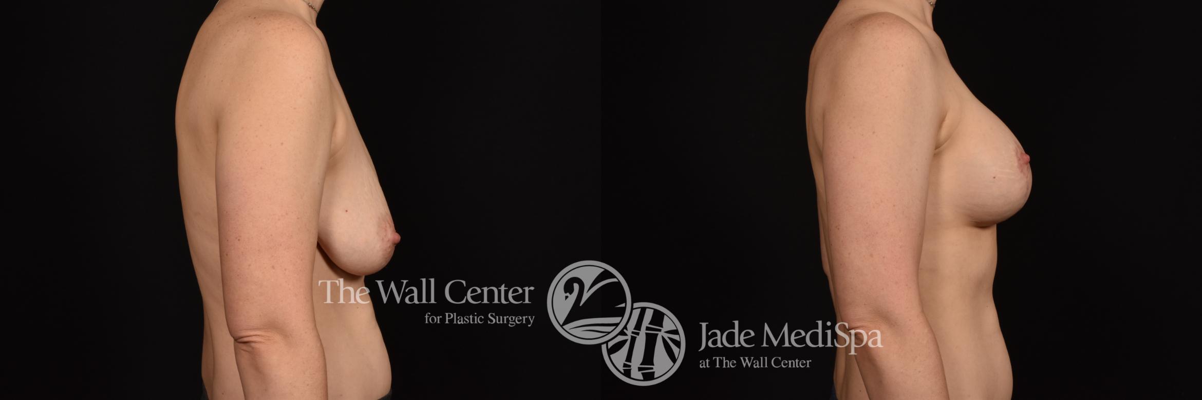 Before & After Breast Augmentation with Lift Case 1016 Right Side View in Shreveport, LA