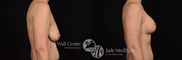 Before & After Breast Augmentation with Lift Case 1016 Right Side View in Shreveport, LA