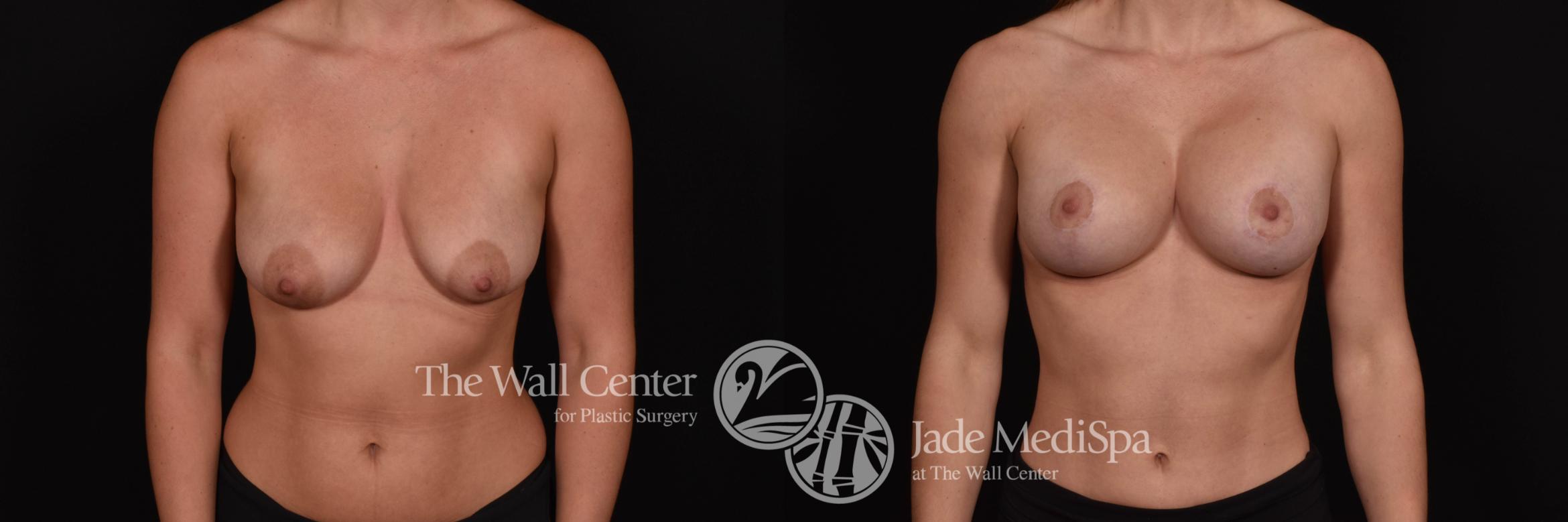 Before & After Breast Augmentation with Lift Case 1018 Front View in Shreveport, LA