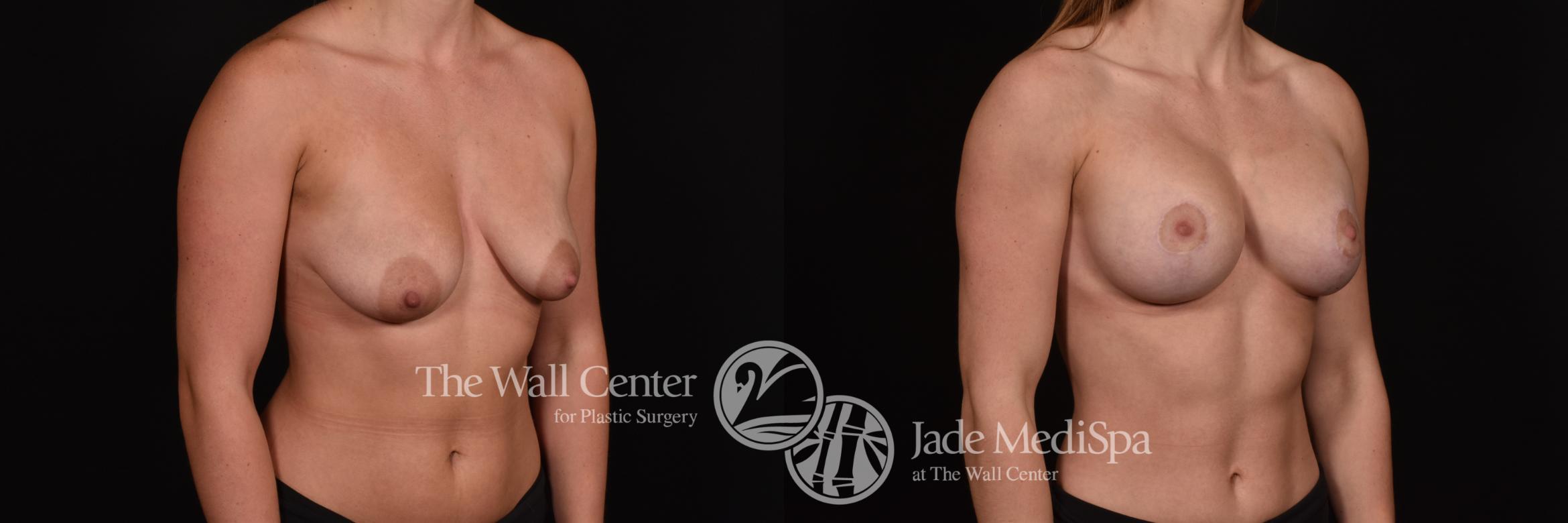 Before & After Breast Augmentation with Lift Case 1018 Right Oblique View in Shreveport, LA