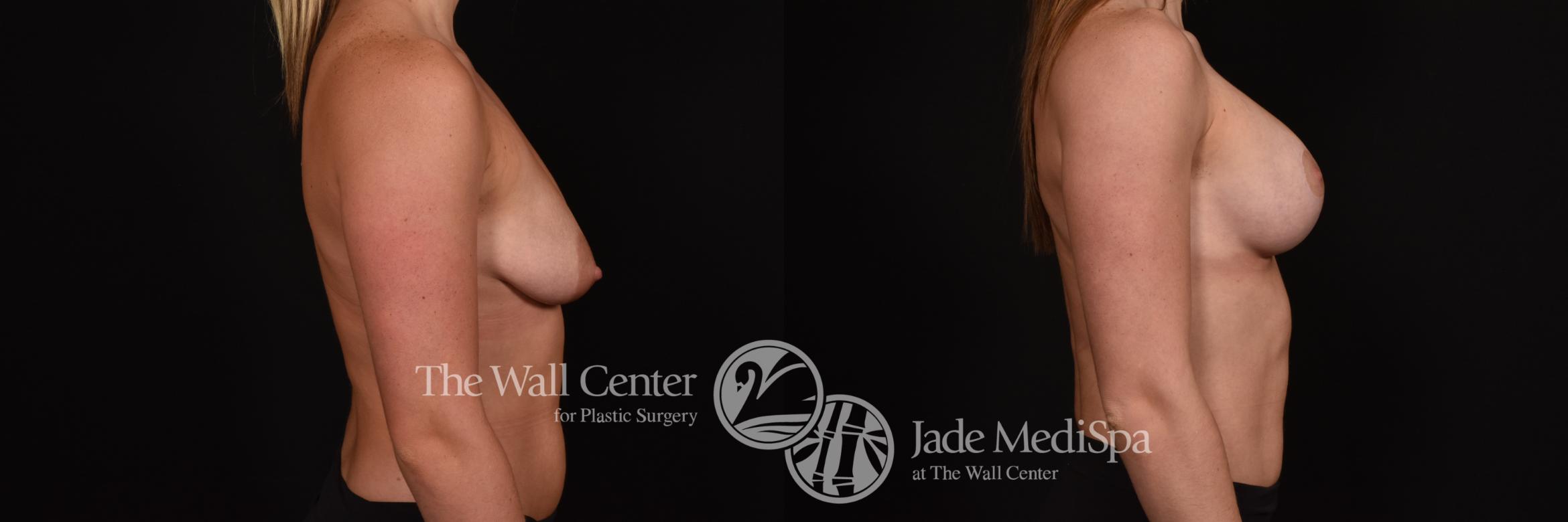 Before & After Breast Augmentation with Lift Case 1018 Right Side View in Shreveport, LA