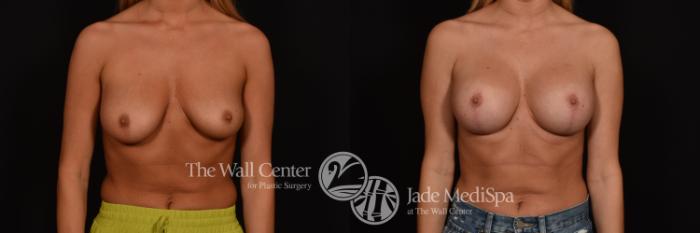 Before & After Breast Augmentation with Lift Case 1019 Front View in Shreveport, LA