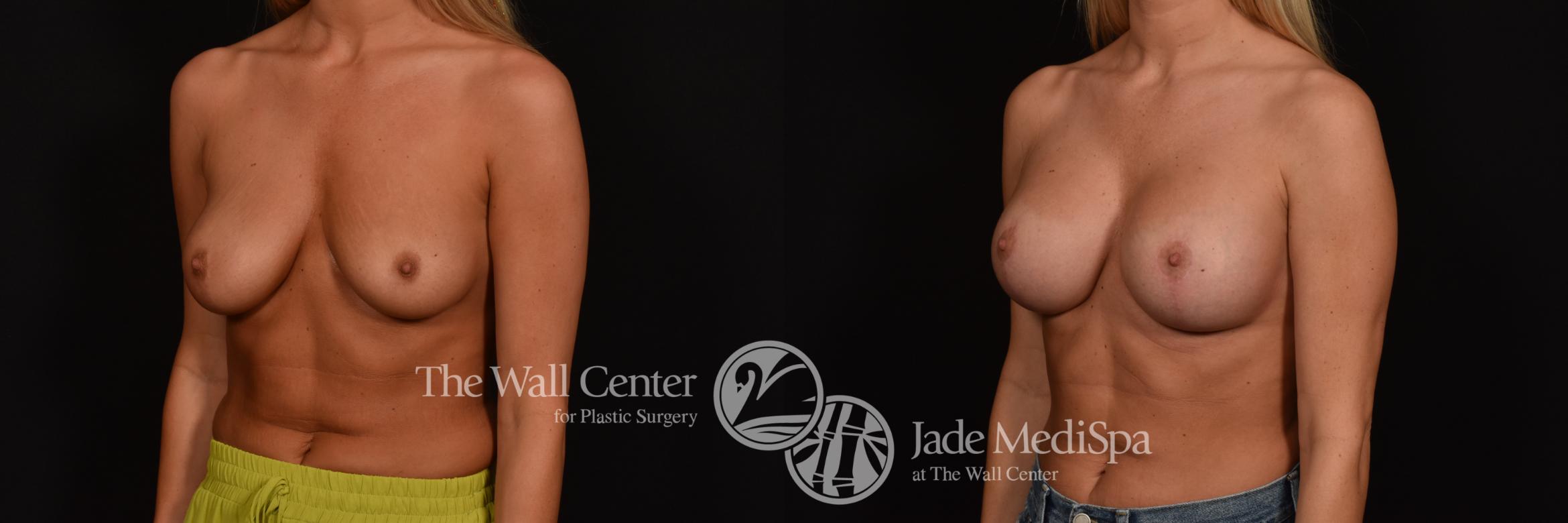 Before & After Breast Augmentation with Lift Case 1019 Left Oblique View in Shreveport, LA