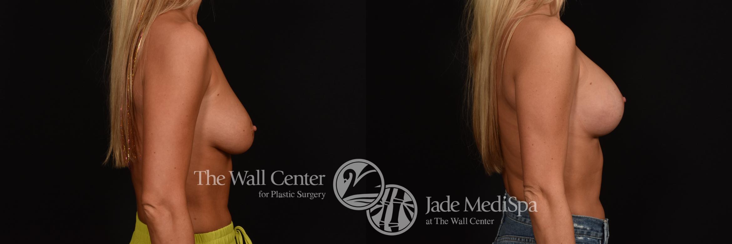 Before & After Breast Augmentation with Lift Case 1019 Right Side View in Shreveport, LA