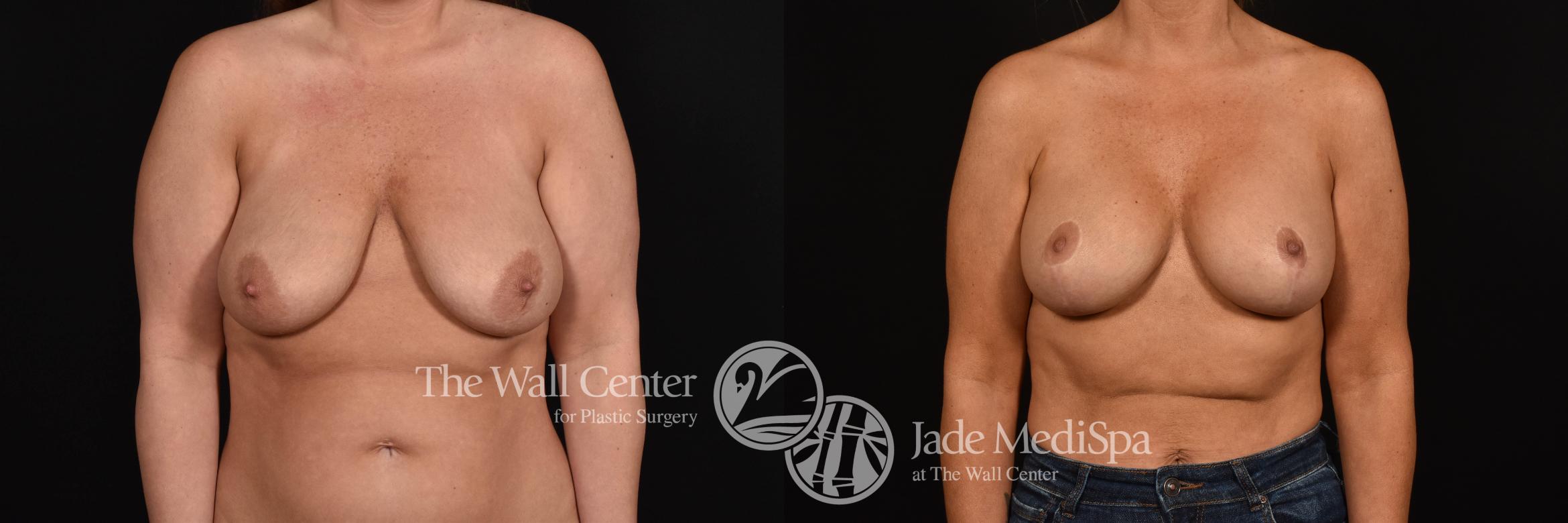 Before & After Breast Augmentation with Lift Case 1021 Front View in Shreveport, LA