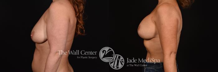 Before & After Breast Augmentation with Lift Case 1021 Left Side View in Shreveport, LA