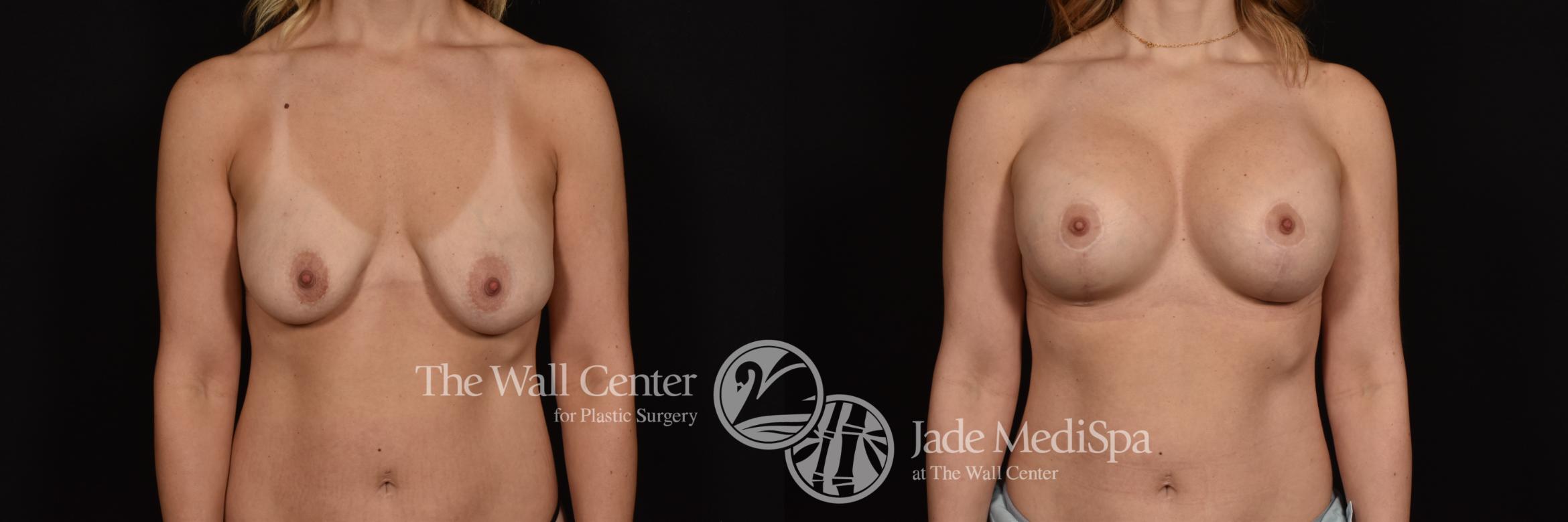 Before & After Breast Augmentation with Lift Case 1023 Front View in Shreveport, LA