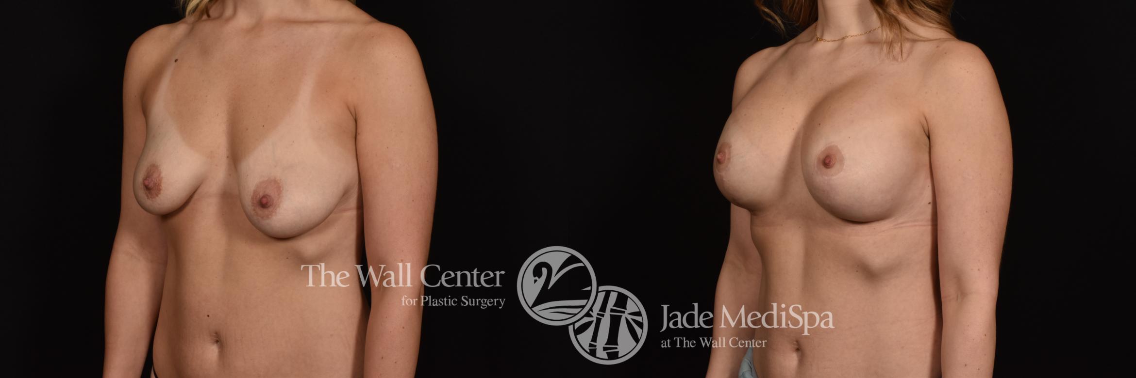 Before & After Breast Augmentation with Lift Case 1023 Left Oblique View in Shreveport, LA