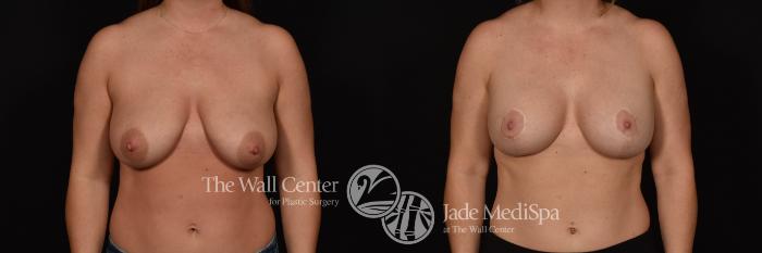 Before & After Breast Augmentation with Lift Case 1025 Front View in Shreveport, LA