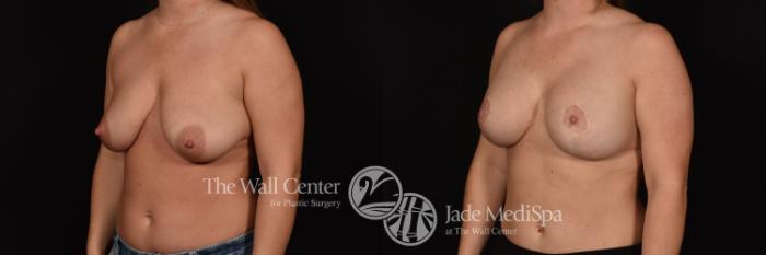 Before & After Breast Augmentation with Lift Case 1025 Left Oblique View in Shreveport, LA