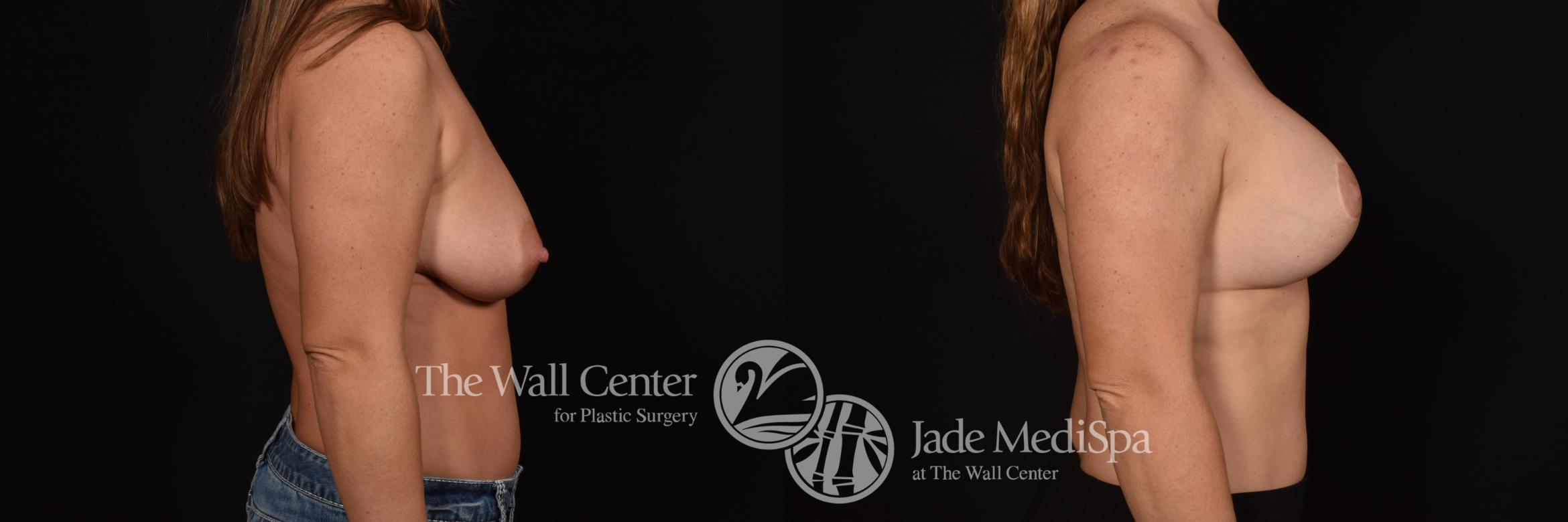 Before & After Breast Augmentation with Lift Case 1025 Right Side View in Shreveport, LA