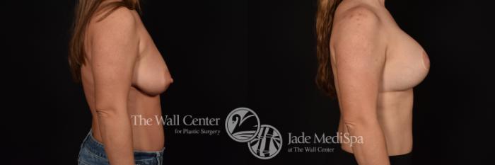Before & After Breast Augmentation with Lift Case 1025 Right Side View in Shreveport, LA