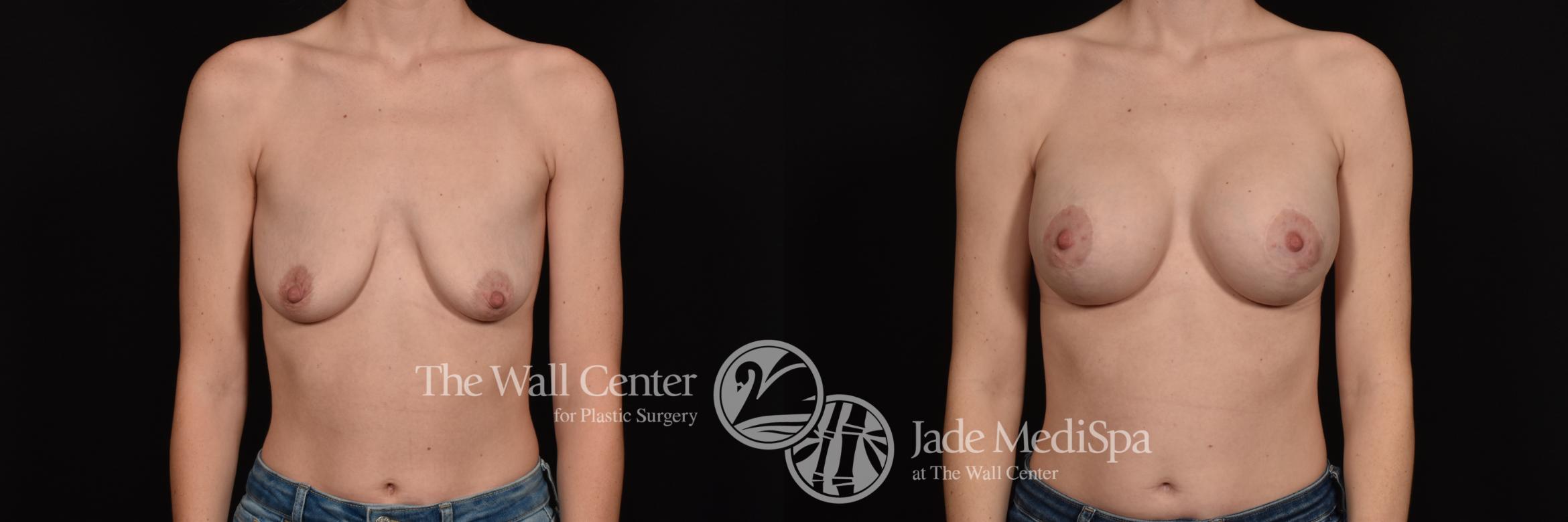 Before & After Breast Augmentation with Lift Case 1027 Front View in Shreveport, LA