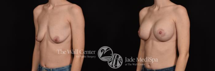 Before & After Breast Augmentation with Lift Case 1027 Left Oblique View in Shreveport, LA