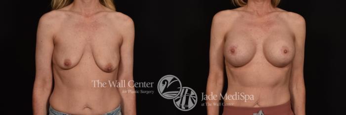 Before & After Breast Augmentation with Lift Case 1033 Front View in Shreveport, LA