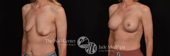 Before & After Breast Augmentation with Lift Case 1033 Left Oblique View in Shreveport, LA