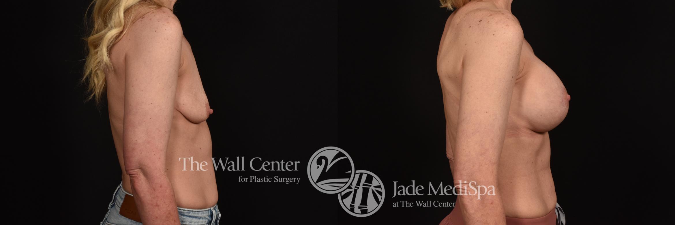 Before & After Breast Augmentation with Lift Case 1033 Right Side View in Shreveport, LA