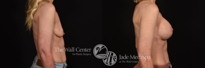 Before & After Breast Augmentation with Lift Case 1033 Right Side View in Shreveport, LA