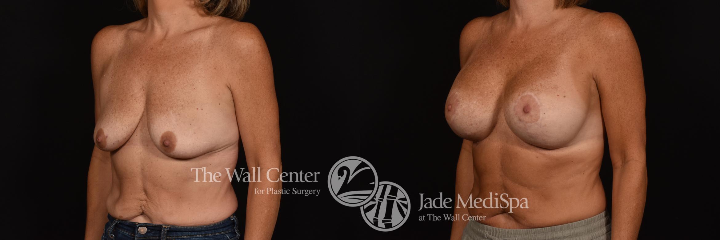 Before & After Breast Augmentation with Lift Case 1034 Left Oblique View in Shreveport, LA